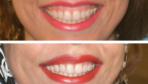 Lip-repositioning