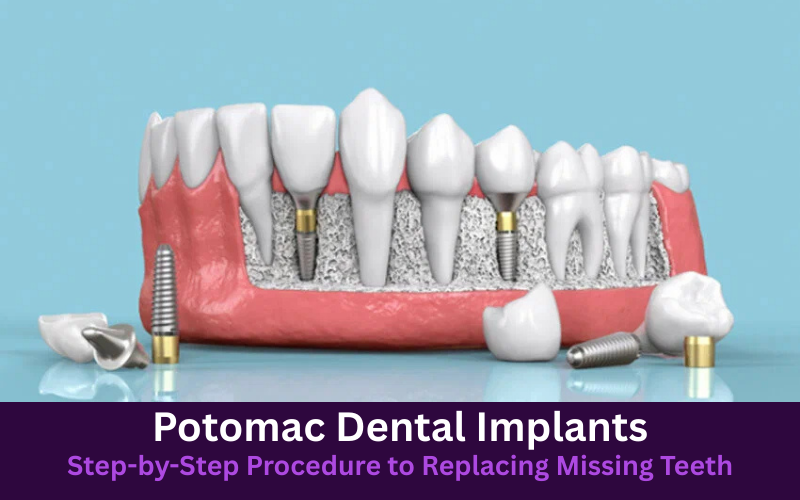 Potomac Dental Implants: Step-by-Step Procedure to Replacing Missing Teeth