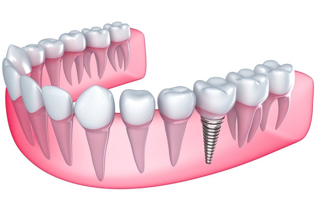 Why Dental Implants in Rockville, MD Are the Best Tooth Replacement Option