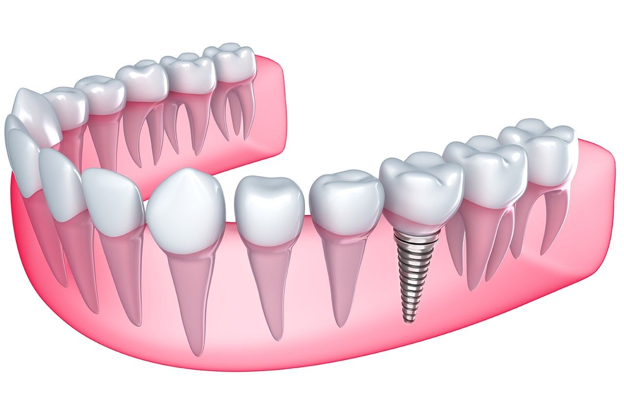 Why Dental Implants in Rockville, MD Are the Best Tooth Replacement Option
