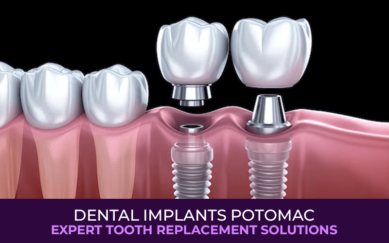 Dental Implants Potomac: Expert Tooth Replacement Solutions