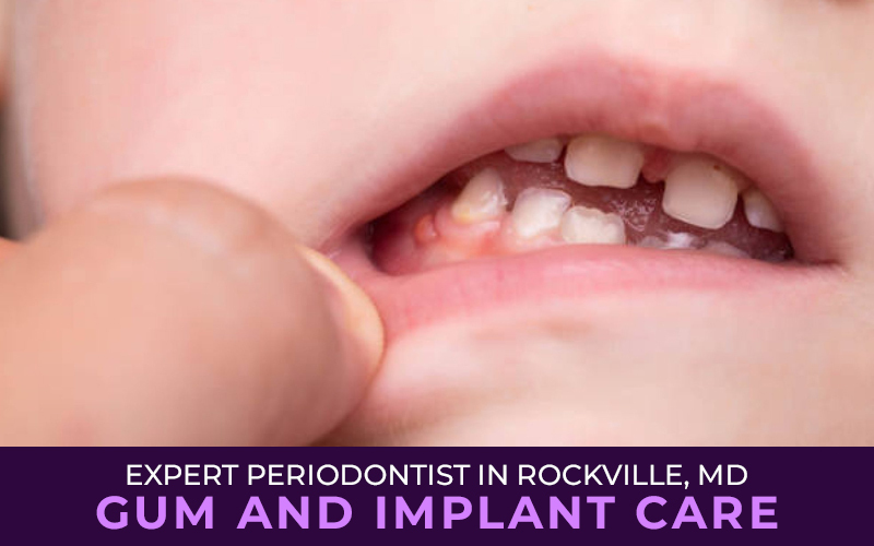 Expert Periodontist in Rockville, MD: Gum and Implant Care